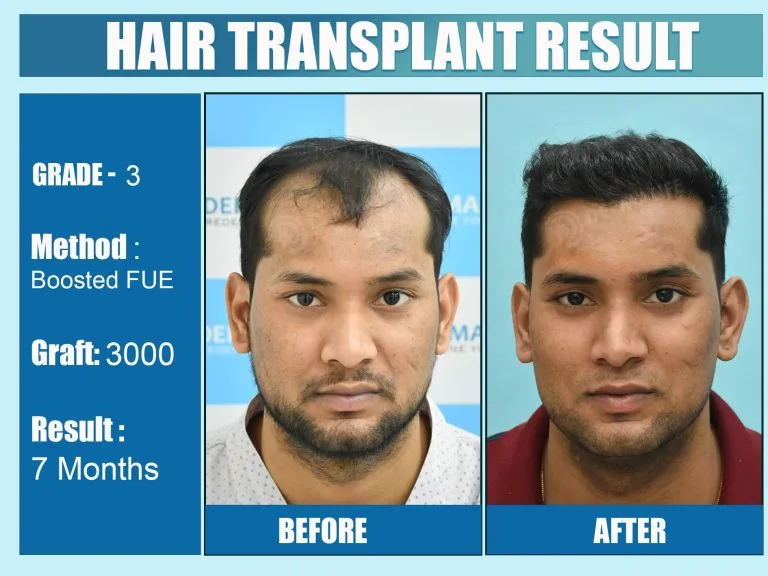 What are The Most Typical Mistakes People Make After Getting A Hair Transplant?
